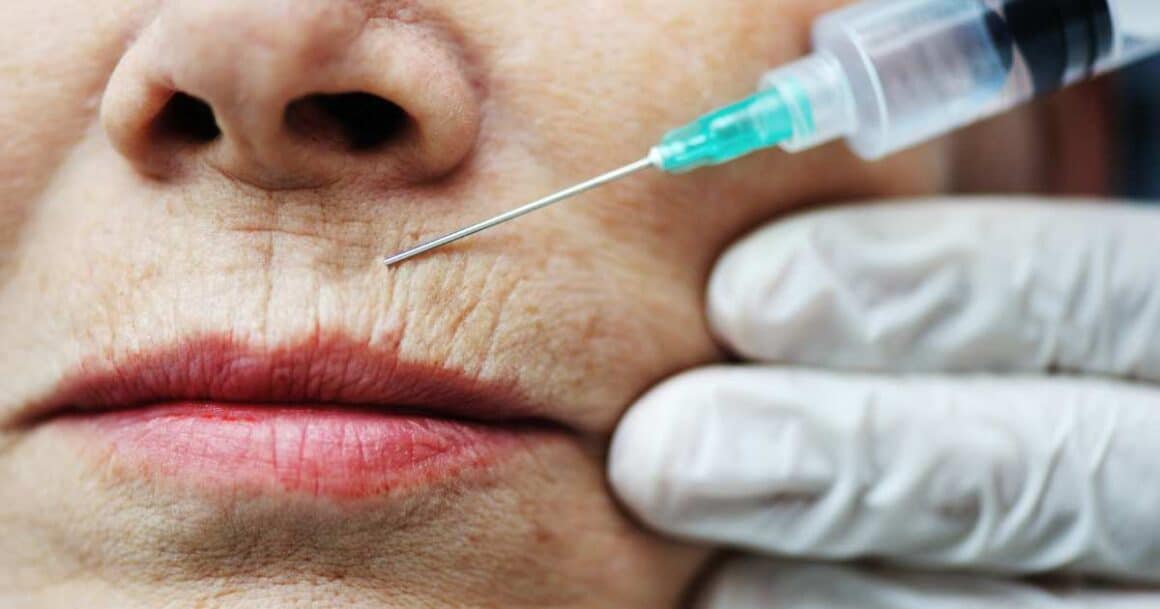 botox for lip lines and wrinkles