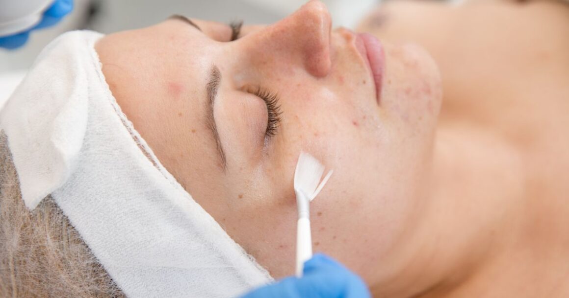 the benefits of a chemical peel