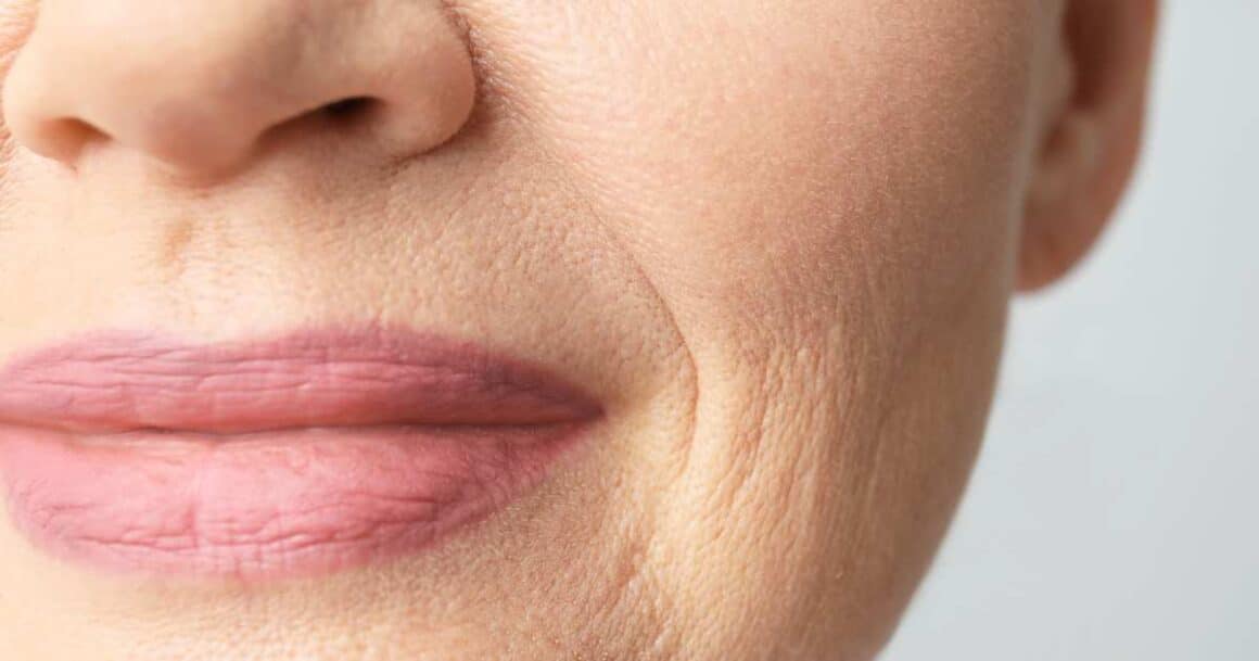 the best treatments for lip lines and wrinkles