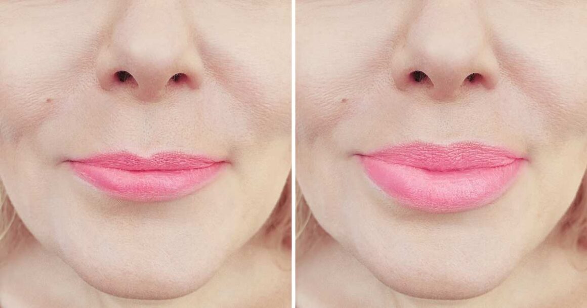 treatment for lip lines before and after