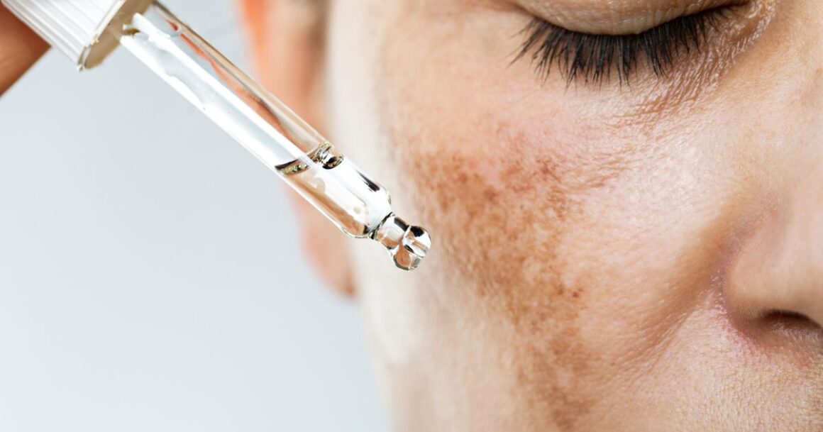 chemical peel for hyperigmentation