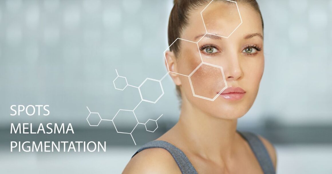 chemical peel for hyperpigmentation 1