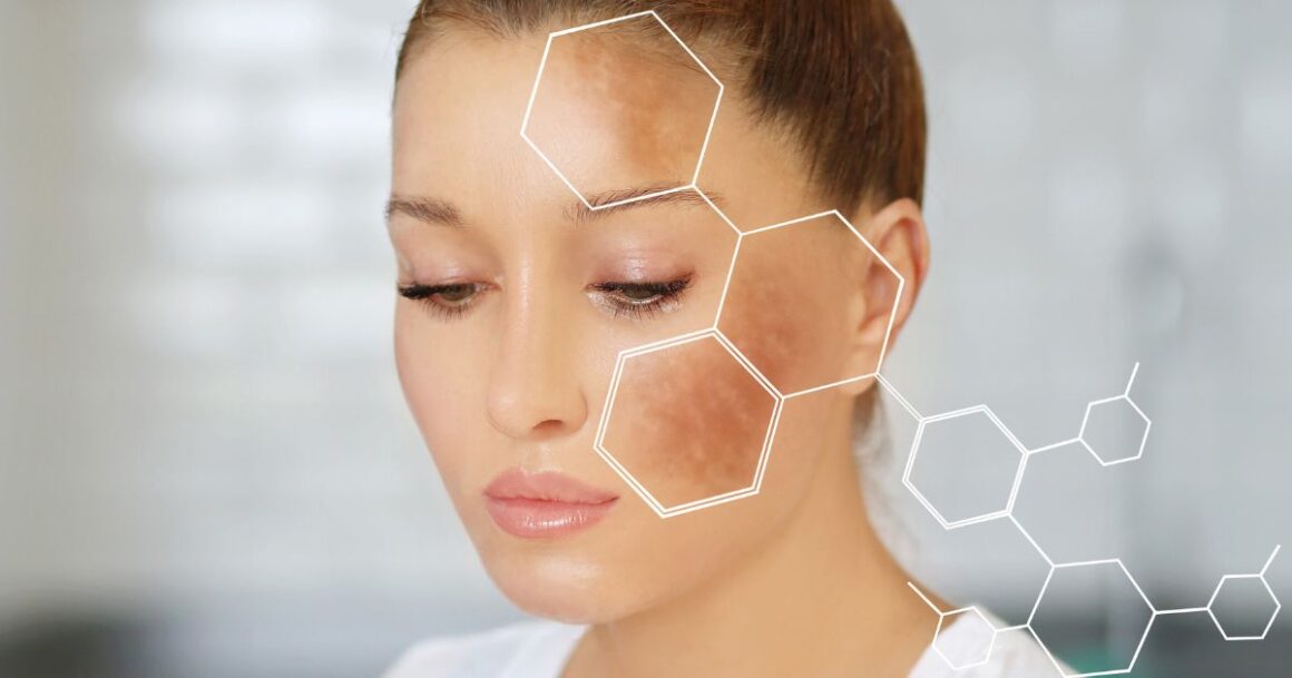 chemical peels for hyperpigmentation